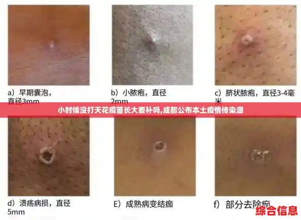 小时候没打天花疫苗长大要补吗,成都公布本土疫情传染源 小时候没打天花疫苗长大要补吗,成都公布本土疫情传染源